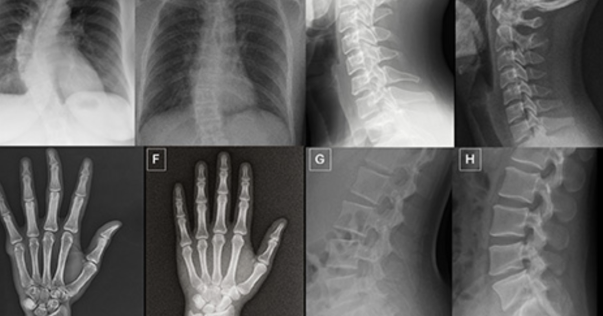 AI-generated deepfake X-rays fool both human radiologists and artificial intelligence systems, raising concerns about medical imaging authenticity